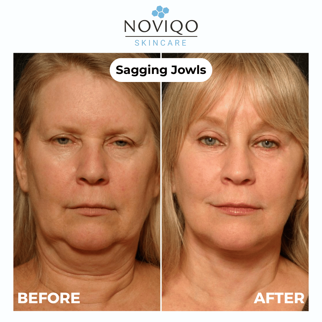 Noviqo™ – AH-8 Neck Firming Cream