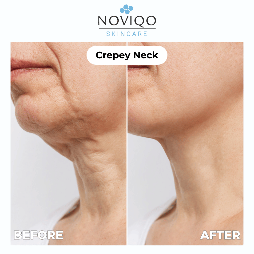 Noviqo™ – AH-8 Neck Firming Cream