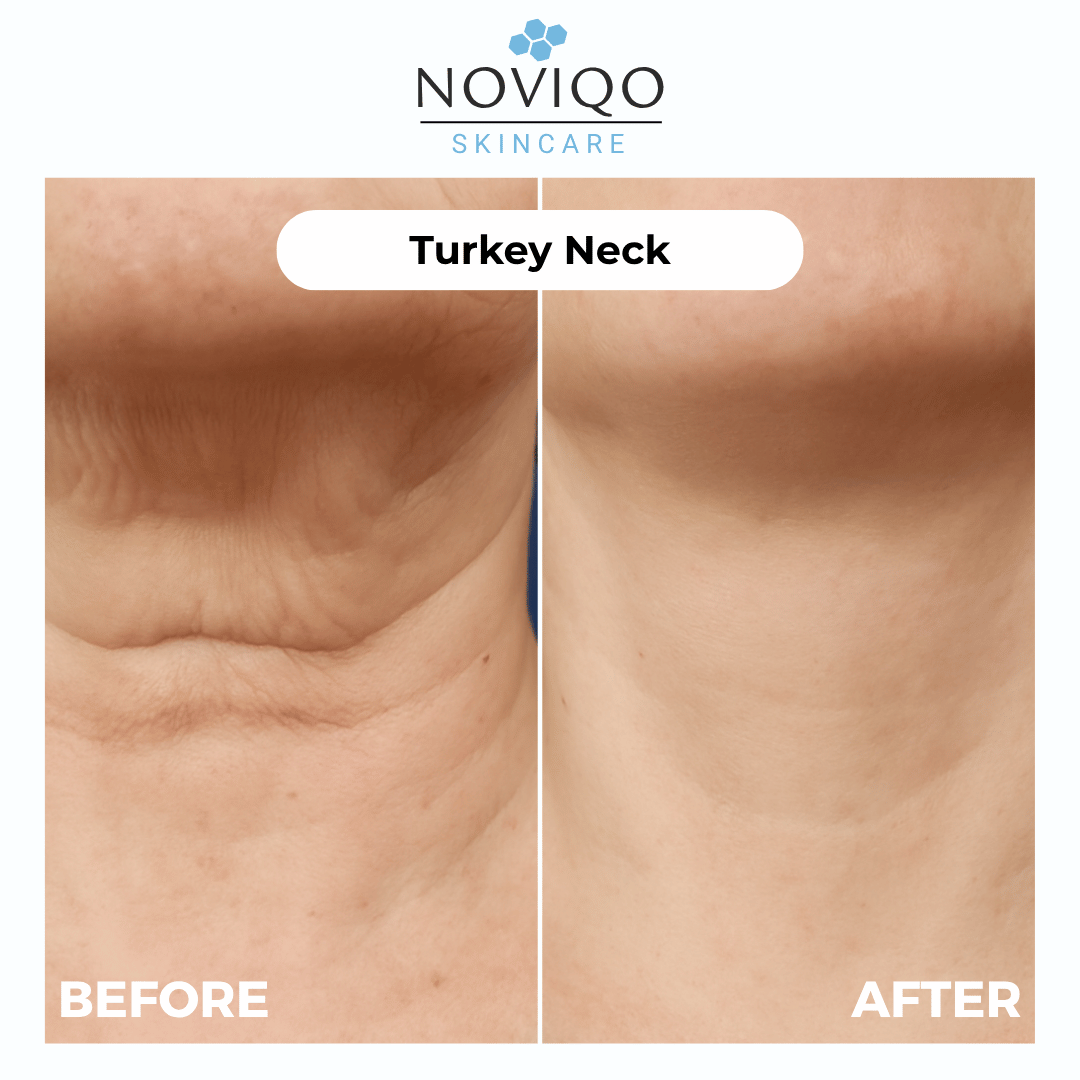 Noviqo™ – Anti-Wrinkle Nano-Silk Collagen Renewal System
