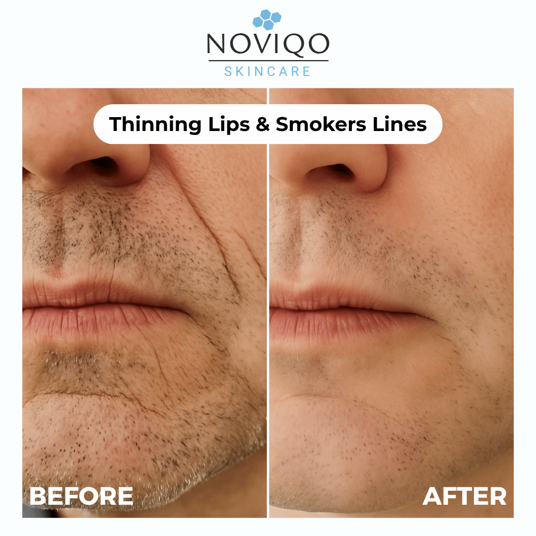 Noviqo™ – Anti-Wrinkle Nano-Silk Collagen Renewal System