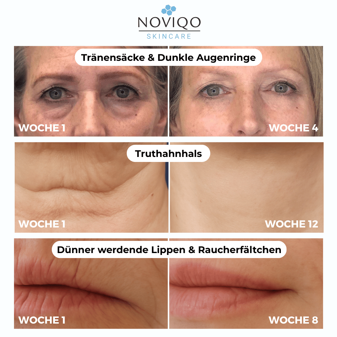 Noviqo™ – Tiefenwirkendes Anti-Falten & Kollagen-Erneuerungssystem