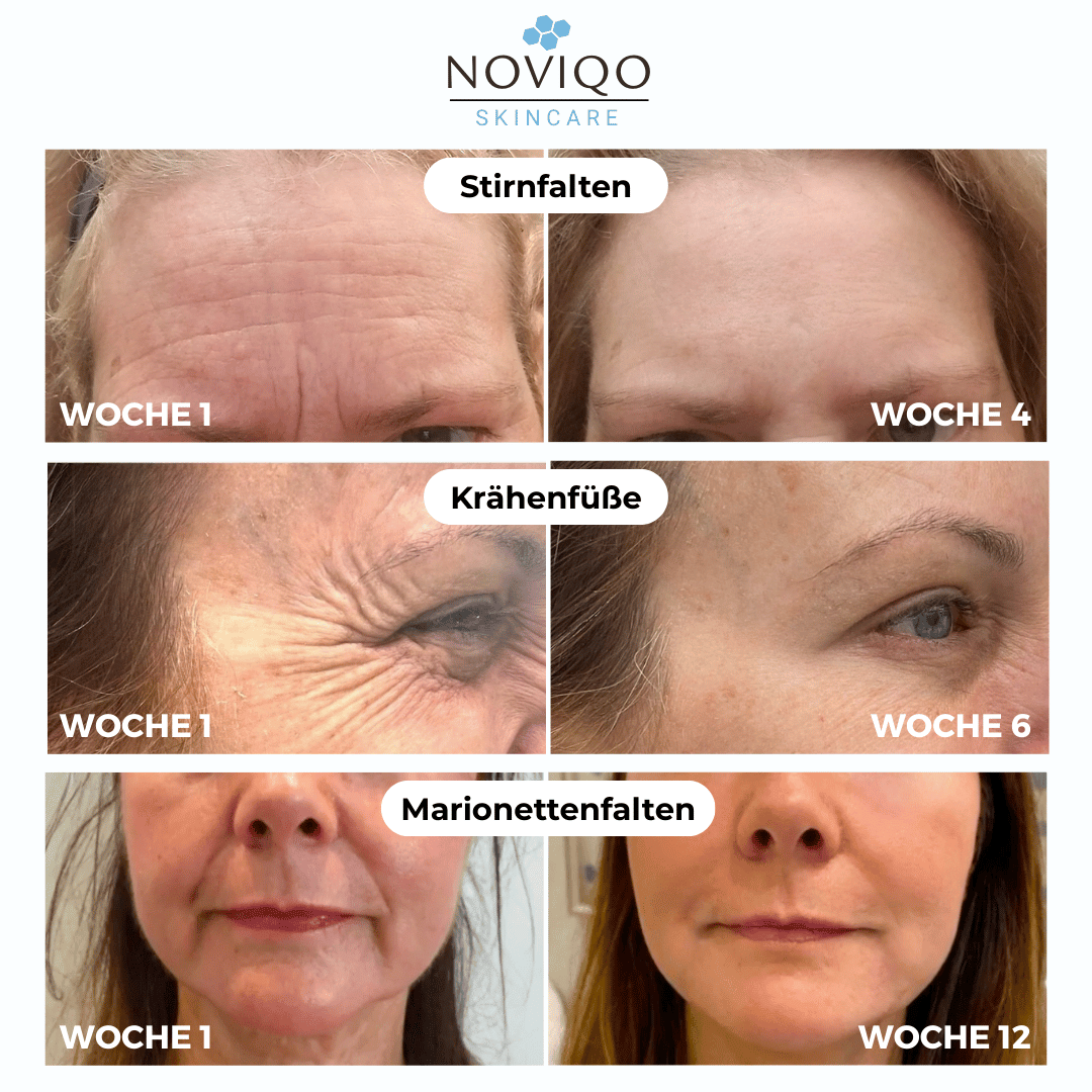 Noviqo™ – Tiefenwirkendes Anti-Falten & Kollagen-Erneuerungssystem